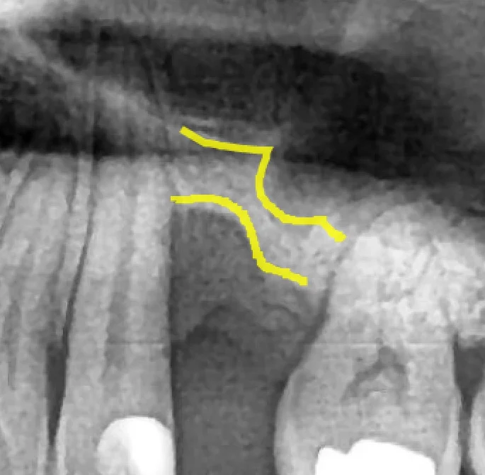 임플란트 뼈이식 수술 전후 파노라마 비교 - 상악동 거상술과 GBR 동시 시행