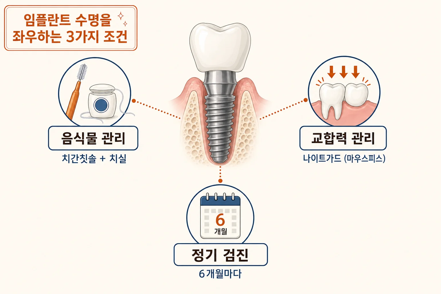 임플란트 수명을 결정하는 3가지 조건 모식도 — 음식물 끼임 관리, 교합력 관리, 정기검진