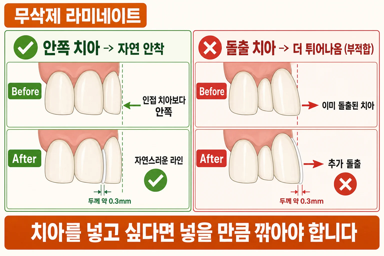 무삭제 라미네이트의 한계 — 치아가 돌출된 경우 도재 판이 그만큼 더 튀어나오게 되는 도식