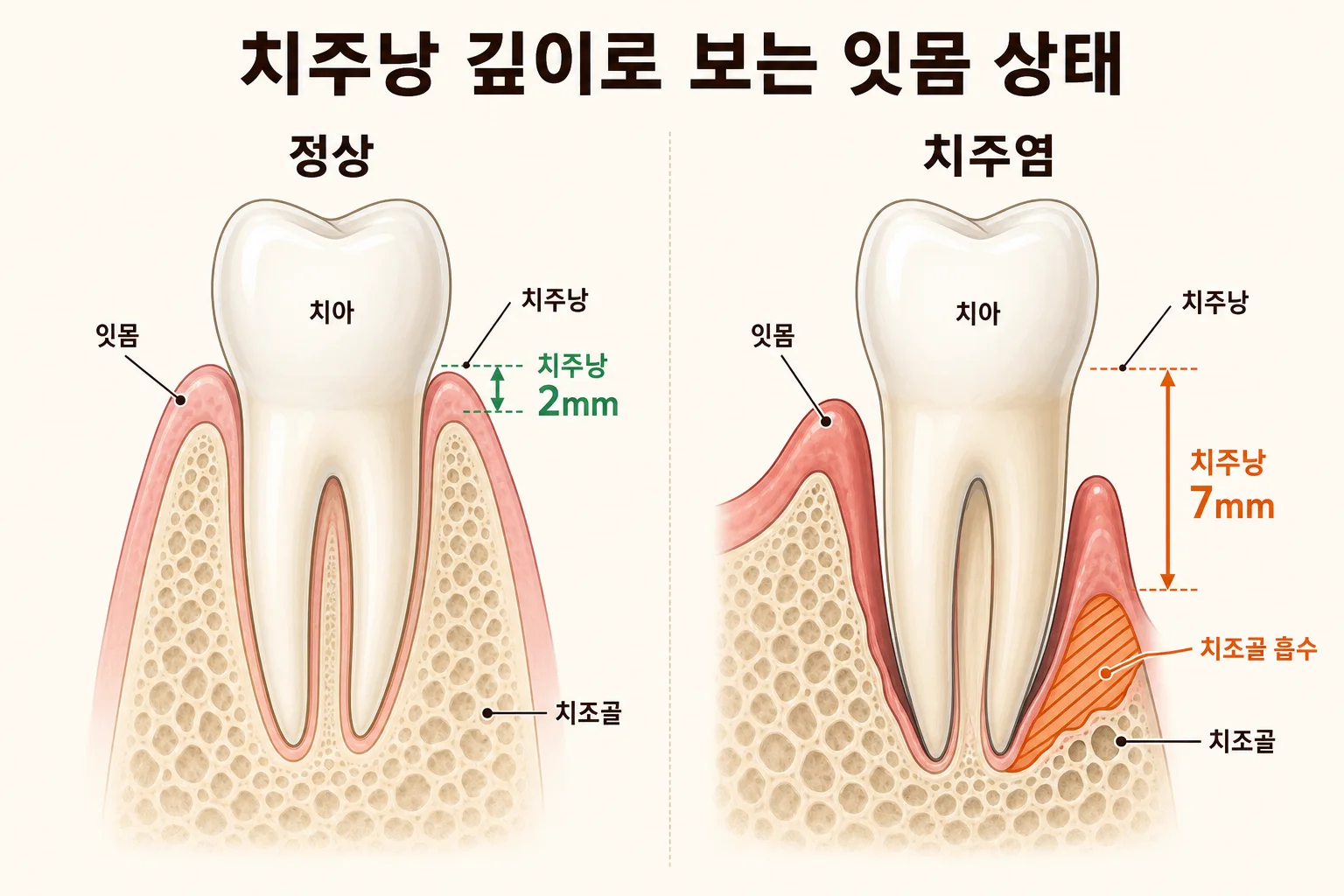 치주낭 깊이 정상 2mm와 치주염 7mm 비교 모식도 | 잇몸치료 한계 설명