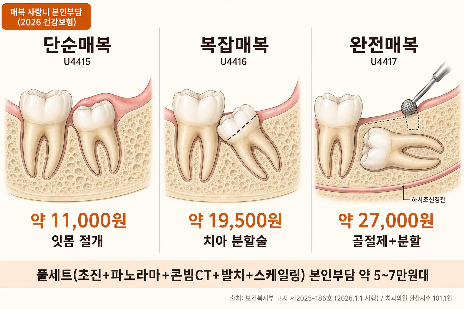매복 사랑니 3단계 본인부담 인포그래픽 — 단순/복잡/완전매복 환자부담 비교